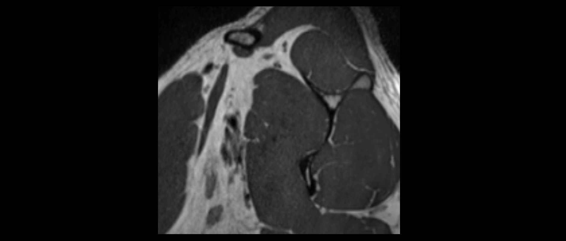 shoulder ligaments sagittal  cross sectional anatomy 3T MRI AI enhanced radiology image -img-00001-00006.webp
